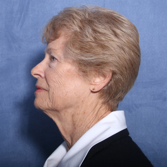 65-74 year old woman treated with Neck Lift (view 2 of 2) before 3179888