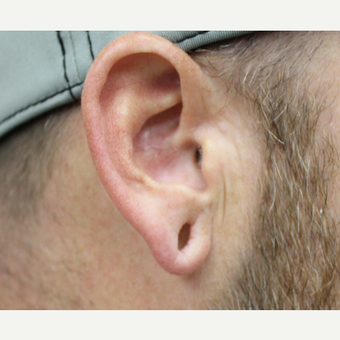 Ear Lobe Surgery before 3417772