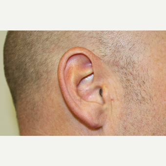 Ear Lobe Surgery after 3417772