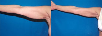 61-year-old woman treated with Liposuction. before 3287606
