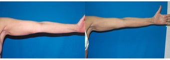 61-year-old woman treated with Liposuction. after 3287606