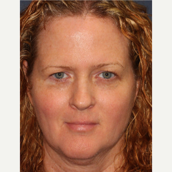 35-44 year old woman treated with Fraxel Dual and Alexandrite for sun damage removal after 3346072