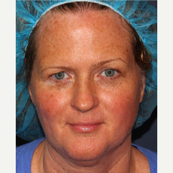 35-44 year old woman treated with Fraxel Dual and Alexandrite for sun damage removal before 3346072