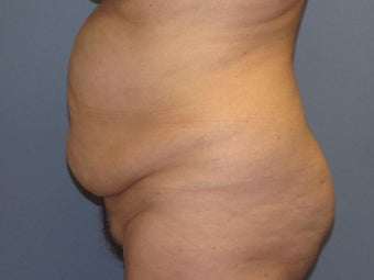 Tummy Tuck on 57-year-old before 842070