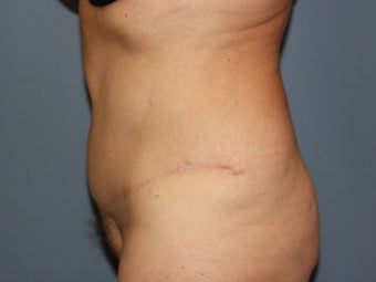 Tummy Tuck on 57-year-old after 842070