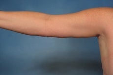 Arm Lift 923724