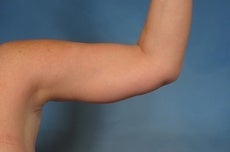 Arm Lift after 923724