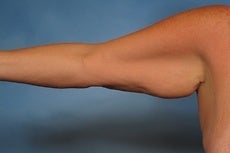 Arm Lift 923724