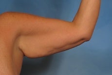 Arm Lift before 923724