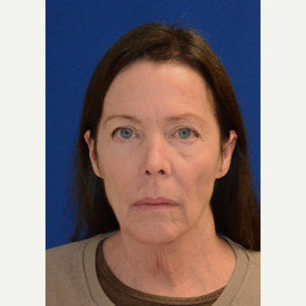 65-74 year old woman treated with Facelift before 3621586