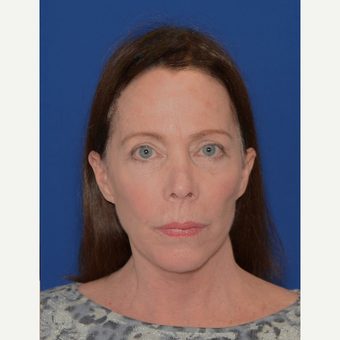 65-74 year old woman treated with Facelift after 3621586