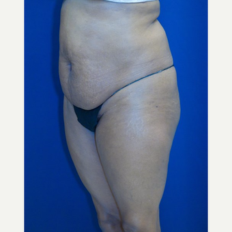 55-64 year old woman treated with Tummy Tuck before 3109940