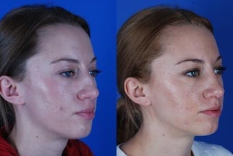 22 Year Old Female had Rhinoplasty Procedure before 1374051