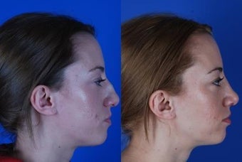 22 Year Old Female had Rhinoplasty Procedure after 1374051