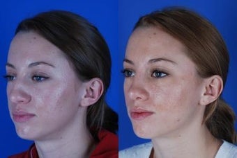 22 Year Old Female had Rhinoplasty Procedure 1374051