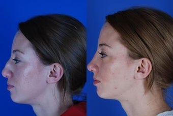 22 Year Old Female had Rhinoplasty Procedure 1374051