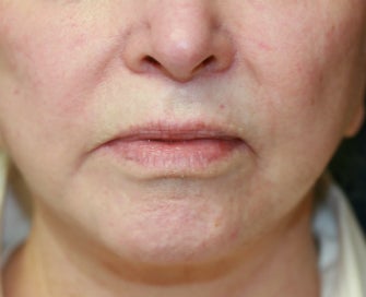 Corner of Lip Lift for "Sad" Expression before 998801