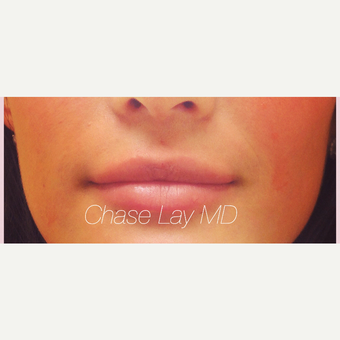 25-34 year old woman treated with Lip Augmentation after 3305111