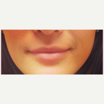 25-34 year old woman treated with Lip Augmentation before 3305111