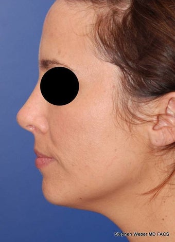 25-34 year old woman treated with Rhinoplasty after 3624186