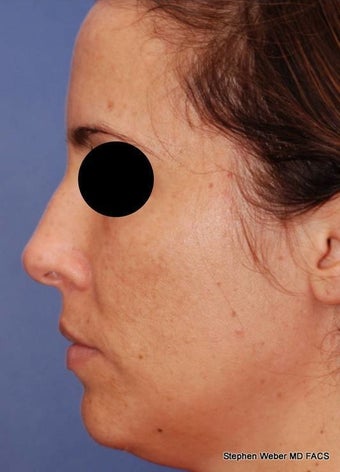 25-34 year old woman treated with Rhinoplasty before 3624186
