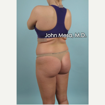25-34 year old woman treated with Brazilian Butt Lift before 3777621