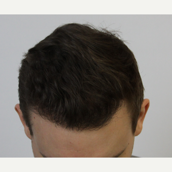 FUE Hair Transplant result 3,500 grafts FUE Top View after 3616844
