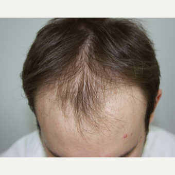 FUE Hair Transplant result 3,500 grafts FUE Top View before 3616844