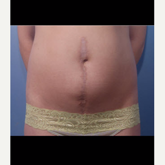 25-34 year old woman treated with Scar Removal after 3725581