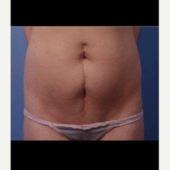 25-34 year old woman treated with Scar Removal before 3725581