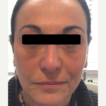 45-54 year old woman treated with Non Surgical Face Lift using dermal fillers and botox. after 3725761