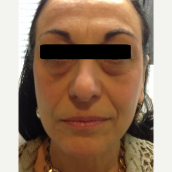 45-54 year old woman treated with Non Surgical Face Lift using dermal fillers and botox. before 3725761