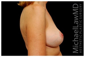 Breast Implants after 1332531