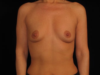 Bilateral Breast Augmentation before 316790