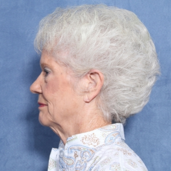 75 and up year old woman treated with Neck Lift (view 2 of 2) before 3175806