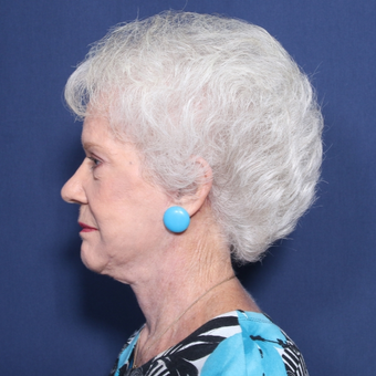 75 and up year old woman treated with Neck Lift (view 2 of 2) after 3175806