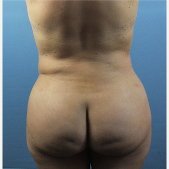 35-44 year old woman treated with Brazilian Butt Lift after 3141326