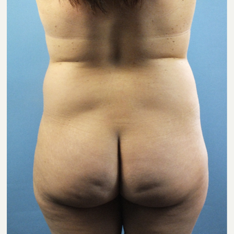 35-44 year old woman treated with Brazilian Butt Lift before 3141326