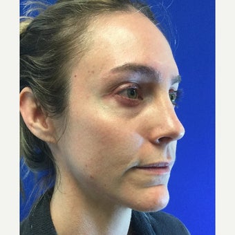 35 Year Old Woman Received Juvederm Cheek Augmentation To Improve Under Eye Hollows before 2074937