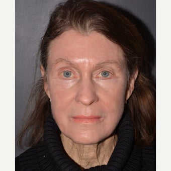 Phenol Croton Oil Peel after 2442471