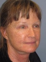 65-74 year old woman treated with Neck Lift after 3103912