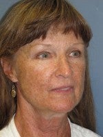 65-74 year old woman treated with Neck Lift before 3103912