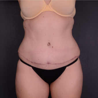 25-34 year old woman treated with Tummy Tuck after 3741624