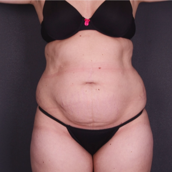 25-34 year old woman treated with Tummy Tuck before 3741624