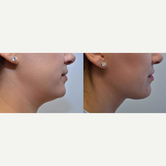 Necklift - 35 year old female with concerns of double chin before 3084040
