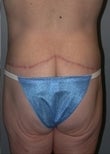 45 year old female patient after 911436
