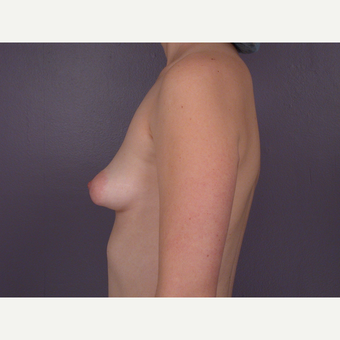 18-24 year old woman treated with Breast Augmentation before 3278101