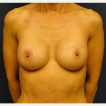 45-54 year old woman treated with Breast Reconstruction after 3241134