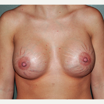 The Effect of Breast Implants on Stretch marks after 3777872