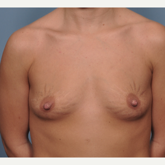 The Effect of Breast Implants on Stretch marks before 3777872